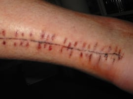 Donnerstag 09.06.2005 nach dem ersten Waschen des Fußes