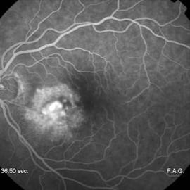 Degenerazione maculare (fluorangiografia)