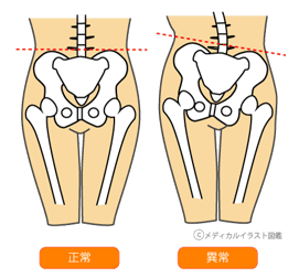 産後の骨盤は不安定なので腰痛や肩こり、頭痛の原因になります