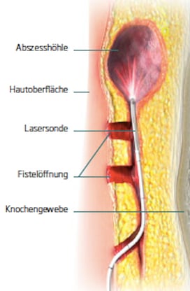 Laser therapy pilonidal cyst
