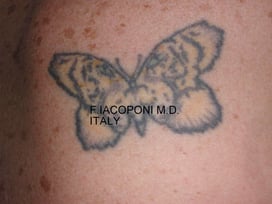 Rimozione tatuaggi Padova