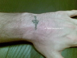 Rimozione laser tattoo