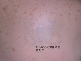 Rimozione laser tatuaggi