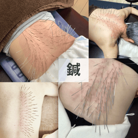 鍼治療について