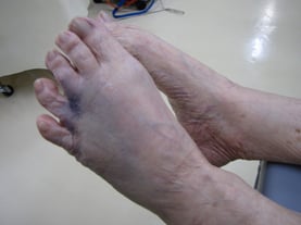 第五中足骨骨折　　保存療法　国分寺こみね鍼灸整骨院