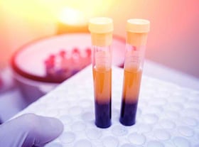 Platelet Rich Plasma for Anal fissure and Pilonidal cyst - proctology Berlin