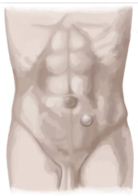 Spieghel Hernie - hernienzentrum.berlin