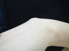 ガングリオン　手技療法　圧迫法　国分寺こみね鍼灸整骨院