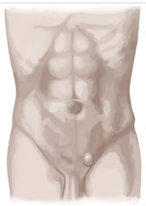 inguinal hernia - hernienzentrum.berlin