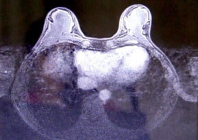 Breast (I) film, toured with Transitional States 2018