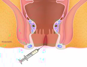 Botox Anal fissure - proctology berlin copv