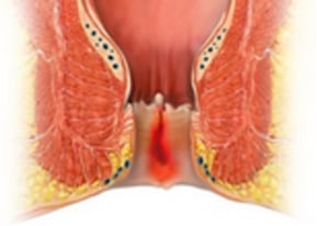 Laser fissure closure (LFC) for anal fissure - proctology berlin