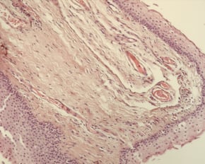 Entferntes Pterygium unter dem Mikroskop bei 10facher Vergrößerung, HE Präparat 