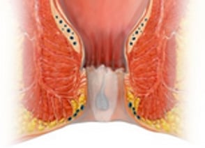 Laser Fissure Cleaning bei der Analfissur - proktologen.berlin