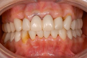 治療中のプロビジョナル・レストレーション