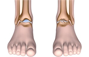 Arthrose, Verschleiss/Knorpelabnutzung