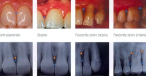 Maladies parodontales