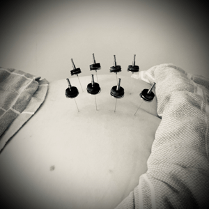 MTC Bienne, Moxa Bienne, Moxibustion Bienne, Techniques additionnelles, acupuncture Bienne, médecine traditionnelle chinoise Bienne, acu natura TCM Bienne 