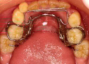下顎ステージⅠ