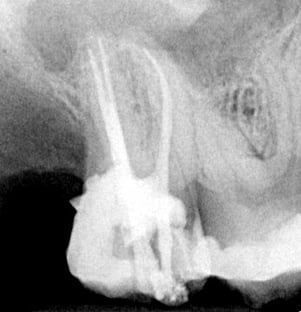 Parodontitis Untersuchung