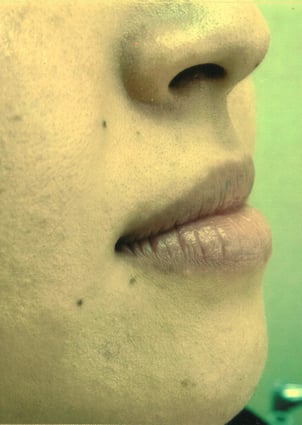 ヒアルロン酸治療前０３