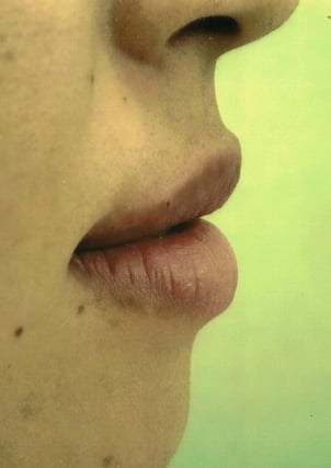 ヒアルロン酸治療後０３