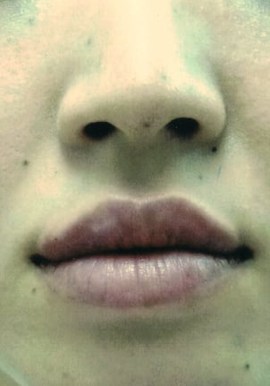 ヒアルﾛン酸治療後０１