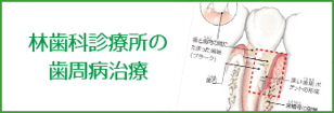 京都市下京区林歯科診療所　歯周病 歯医者