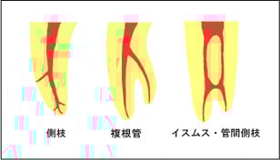 難しい根管・根管トラブル