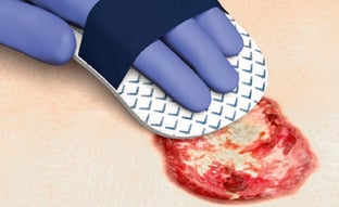 Cutimed Debri Clean Anwendung auf einer Wunde