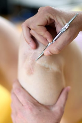 Eine Therapeutin für Narbenentstörung behandelt das Knie eines Patienten mit einer Narbe. Er mobilisiert die Narbe mit den Händen und einem Hilfsmittel, um Verklebungen zu lösen, Muskeln und Faszien gleitfähiger zu machen, und so Knieschmerzen zu lindern.