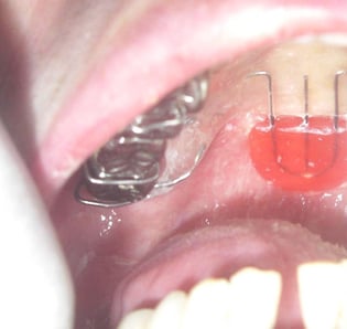 パラタルリフト・PLP