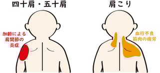 肩こりとの違いは？