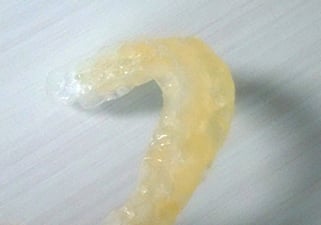 保険診療の睡眠時無呼吸症マウスピース