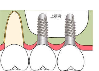 上顎奥歯のインプラント