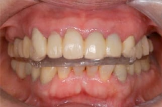 スプリントを装着