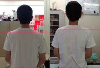 左：施術前　右：施術後