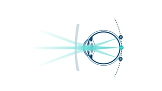 Grafik über die Funktionsweise von Minus-Brillengläsern