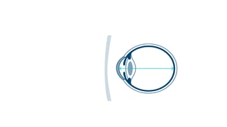 Grafik eines in die Länge gewachsenen Auges