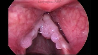 papillomatose laryngée? Francis NYOCK, ostéopathe D.O. spécialiste de la voix ( à Lyon et à Albigny sur Sâone)