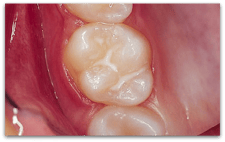 Versiegelte Fissur (© Doc S)