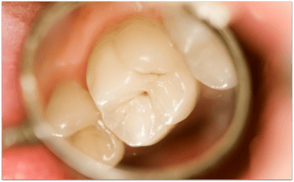 Fissurenkaries an einem Backenzahn (© Zsolt Bota Finna - Fotolia.com)