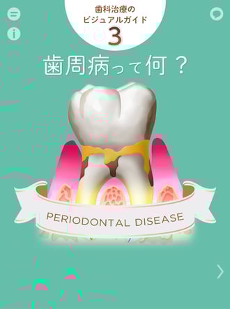 歯周病って何？