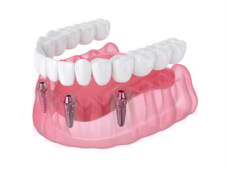 MKG: Implantate Sofortversorgung All-on-4 und All-on-6 bei Zahnarzt Dr. Beniashvili, Oralchirurgie und Implantologie in Schorndorf