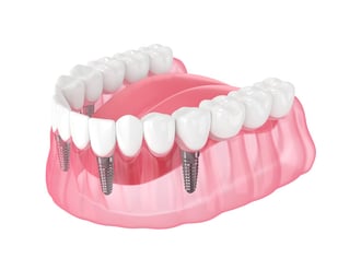 MKG: Längere, mehrgliedrige Implantate bei Zahnarzt Dr. Beniashvili, Oralchirurgie und Implantologie in Schorndorf