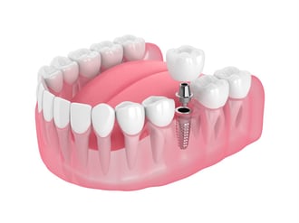 MKG: Implantatversorgung in der Zahnarztpraxis Dr. Beniashvili, Oralchirurgie und Implantologie in Schorndorf