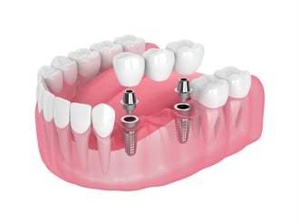 MKG: Mehrgliedrige Implantatversorgung in der Zahnarztpraxis Dr. Beniashvili, Oralchirurgie und Implantologie in Schorndorf