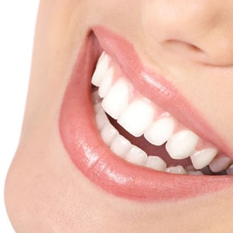 blanqueamiento dental