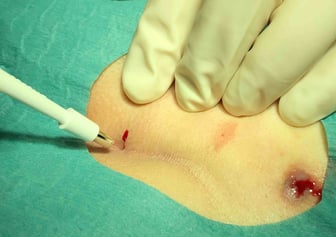 OP pit picking pilonidal cyst (sinus pilonidalis)