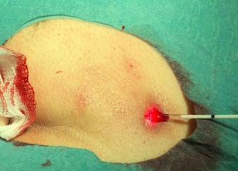 OP laser therapy pilonidal cyst (sinus pilonidalis)